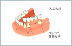 大岸歯科クリニックインプラントイラスト01