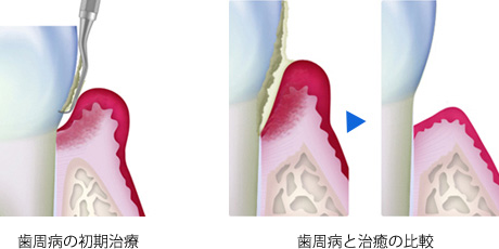 大岸歯科クリニック歯周病比較